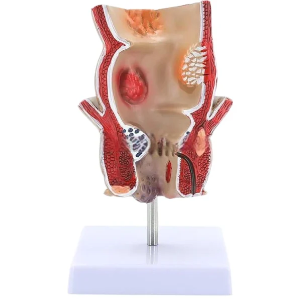 Medical Anatomical Hemorrhoid Model for Pathological Demonstration Enhanced Education and Patient Communication
