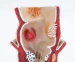 Medical Anatomical Hemorrhoid Model for Pathological Demonstration Enhanced Education and Patient Communication