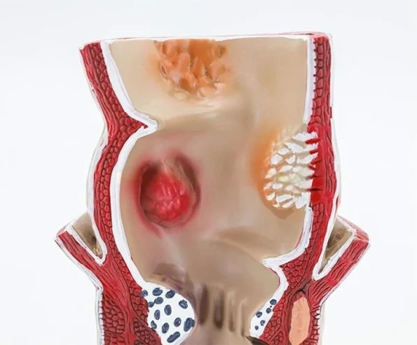 Medical Anatomical Hemorrhoid Model for Pathological Demonstration Enhanced Education and Patient Communication