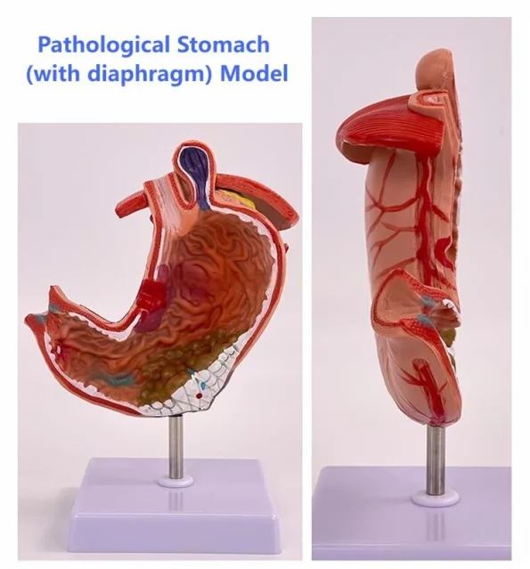 Medical Pathological Stomach Model with Diaphragm | Anatomical Teaching Tool