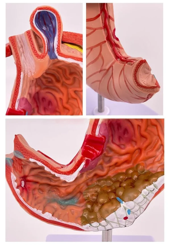 Medical Pathological Stomach Model with Diaphragm | Anatomical Teaching Tool