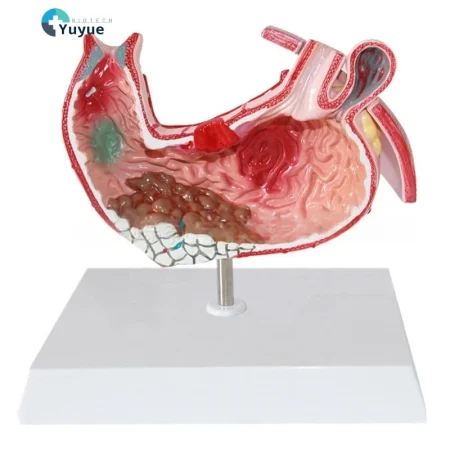 Medical Science Education & Demonstration Model Plastic PVC Anatomical Pathological Stomach for Disease Visualization