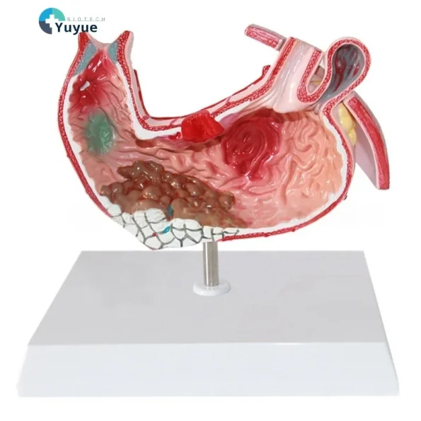 Medical Science Education & Demonstration Model Plastic PVC Anatomical Pathological Stomach for Disease Visualization