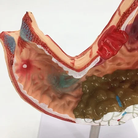 Medical Science Education & Demonstration Model Plastic PVC Anatomical Pathological Stomach for Disease Visualization