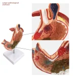 Medical Science Education & Demonstration Model Plastic PVC Anatomical Pathological Stomach for Disease Visualization