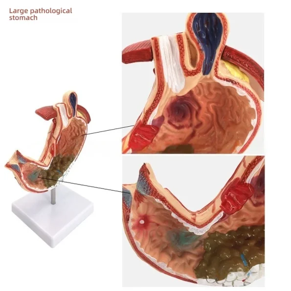 Medical Science Education & Demonstration Model Plastic PVC Anatomical Pathological Stomach for Disease Visualization