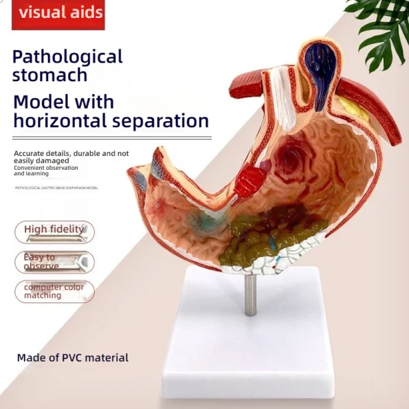 Medical Science Education & Demonstration Model Plastic PVC Anatomical Pathological Stomach for Disease Visualization