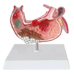Medical Science Education & Demonstration Model Plastic PVC Anatomical Pathological Stomach for Disease Visualization