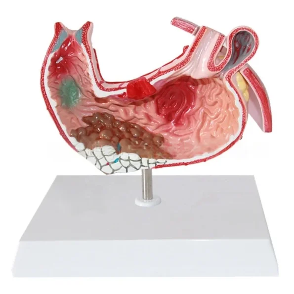 Medical Science Education & Demonstration Model Plastic PVC Anatomical Pathological Stomach for Disease Visualization