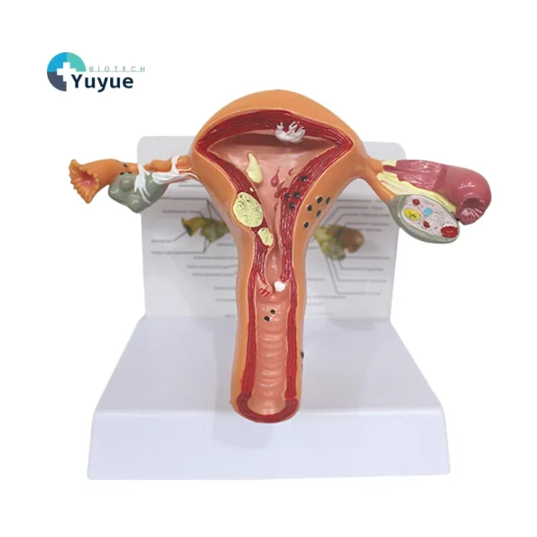 Medical Science Model of Uterine and Ovarian Pathological Lesions