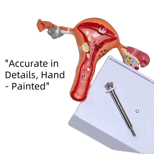 Medical Science Model of Uterine and Ovarian Pathological Lesions