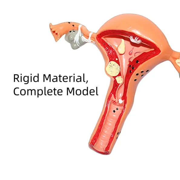 Medical Science Model of Uterine and Ovarian Pathological Lesions