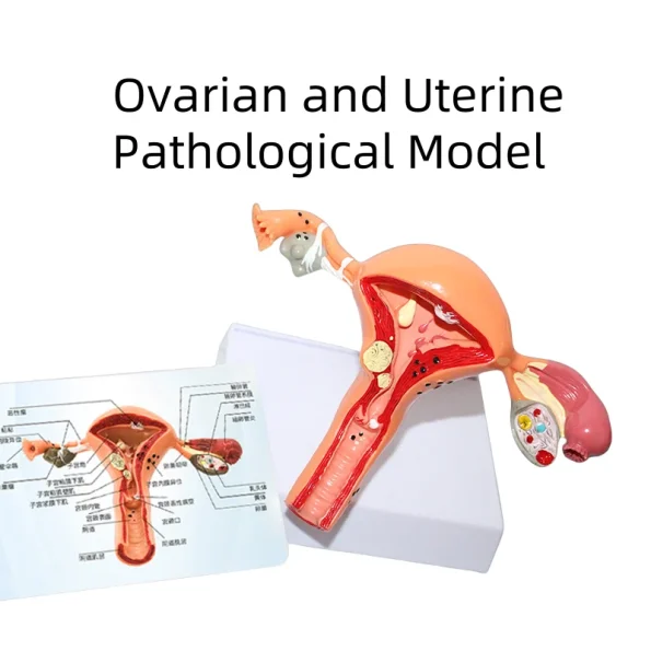 Medical Science Model of Uterine and Ovarian Pathological Lesions