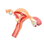 Medical Science Model of Uterine and Ovarian Pathological Lesions