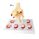Medical Teaching Model Knee Meniscus Injury Model for Sports Medicine & Anatomy Education