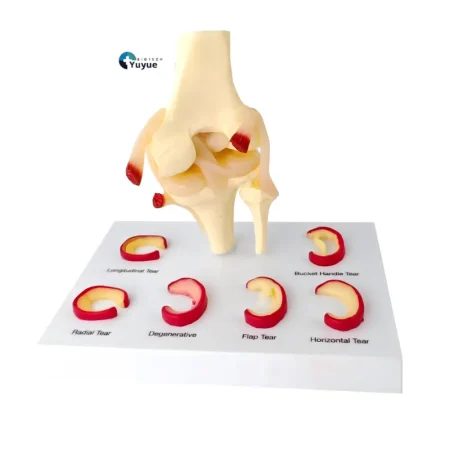 Medical Teaching Model Knee Meniscus Injury Model for Sports Medicine & Anatomy Education
