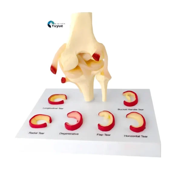 Medical Teaching Model Knee Meniscus Injury Model for Sports Medicine & Anatomy Education