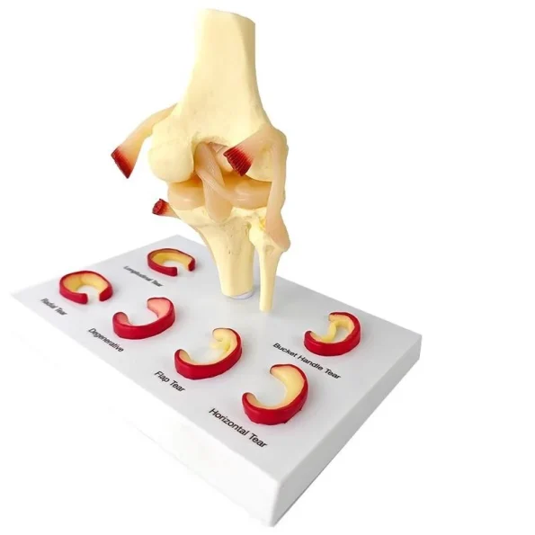 Medical Teaching Model Knee Meniscus Injury Model for Sports Medicine & Anatomy Education