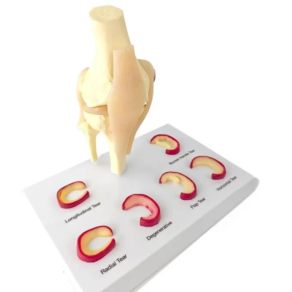 Medical Teaching Model Knee Meniscus Injury Model for Sports Medicine & Anatomy Education