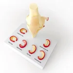 Medical Teaching Model Knee Meniscus Injury Model for Sports Medicine & Anatomy Education