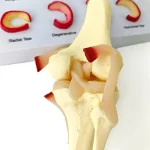 Medical Teaching Model Knee Meniscus Injury Model for Sports Medicine & Anatomy Education