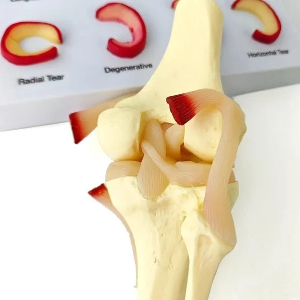 Medical Teaching Model Knee Meniscus Injury Model for Sports Medicine & Anatomy Education