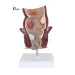 Medical Teaching Model Rectal Pathology Model for Proctology & Anatomy Education