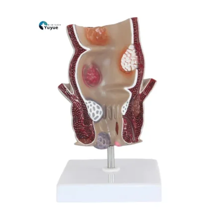 Medical Teaching Model Rectal Pathology Model for Proctology & Anatomy Education