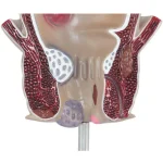 Medical Teaching Model Rectal Pathology Model for Proctology & Anatomy Education