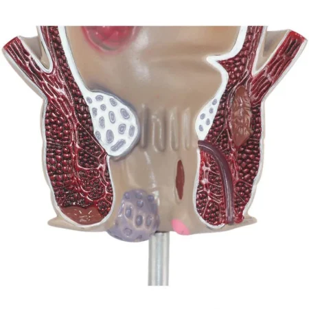 Medical Teaching Model Rectal Pathology Model for Proctology & Anatomy Education