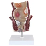 Medical Teaching Model Rectal Pathology Model for Proctology & Anatomy Education