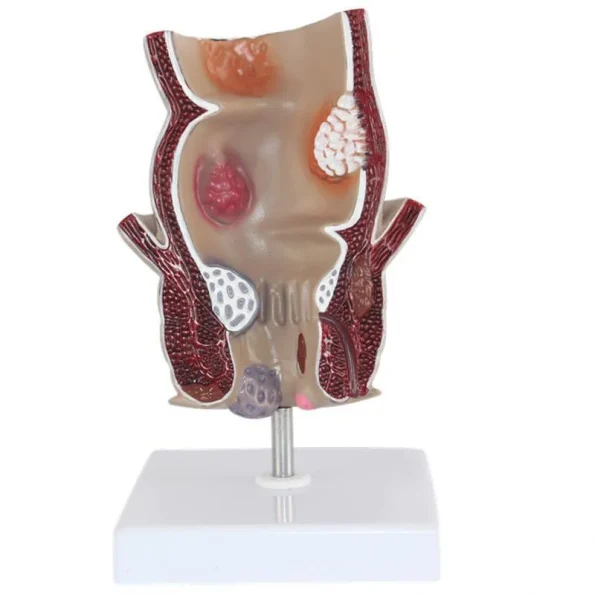 Medical Teaching Model Rectal Pathology Model for Proctology & Anatomy Education
