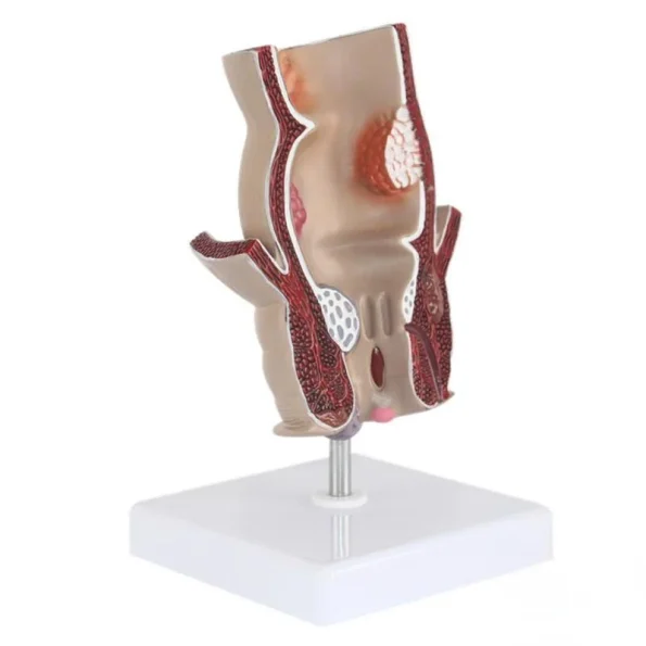 Medical Teaching Model Rectal Pathology Model for Proctology & Anatomy Education