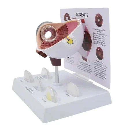 Pathological Eye Model with Interchangeable Lenses for Cataract Demonstration
