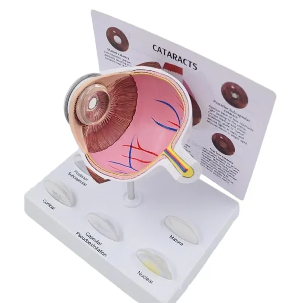 Pathological Eye Model with Interchangeable Lenses for Cataract Demonstration