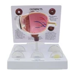 Pathological Eye Model with Interchangeable Lenses for Cataract Demonstration