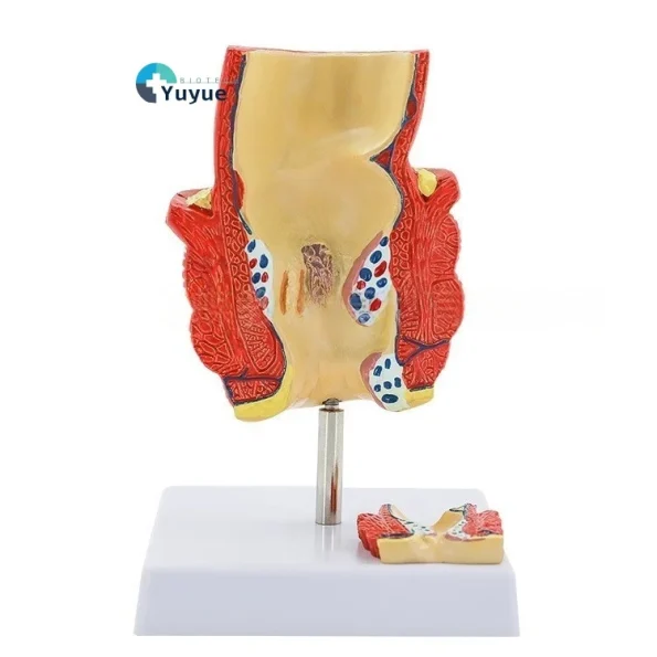 Proctology Colorectal Education Model Rectal Hemorrhoid Anatomy with Internal External Hemorrhoids for Medical School Training