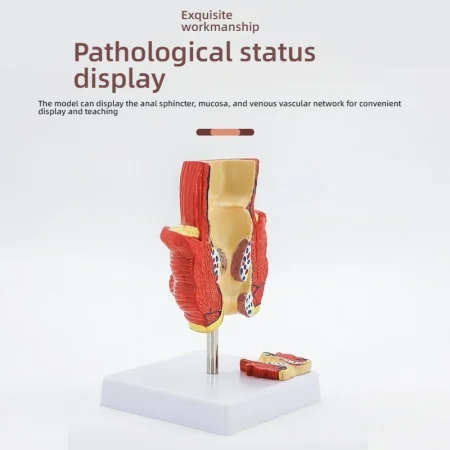 Proctology Colorectal Education Model Rectal Hemorrhoid Anatomy with Internal External Hemorrhoids for Medical School Training