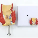 Proctology Colorectal Education Model Rectal Hemorrhoid Anatomy with Internal External Hemorrhoids for Medical School Training