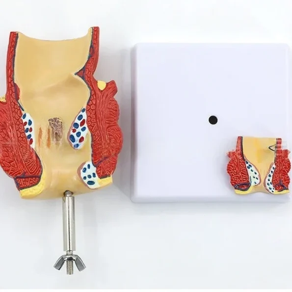 Proctology Colorectal Education Model Rectal Hemorrhoid Anatomy with Internal External Hemorrhoids for Medical School Training