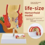 Proctology Colorectal Education Model Rectal Hemorrhoid Anatomy with Internal External Hemorrhoids for Medical School Training