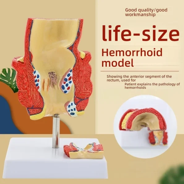 Proctology Colorectal Education Model Rectal Hemorrhoid Anatomy with Internal External Hemorrhoids for Medical School Training