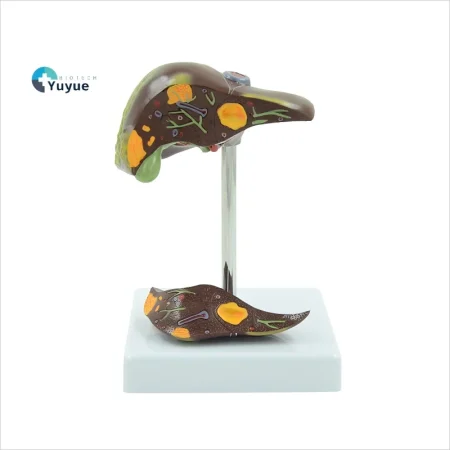 PVC Pathological Liver Model Visualize Common Hepatic & Gallbladder Disorders