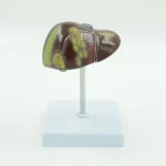 PVC Pathological Liver Model Visualize Common Hepatic & Gallbladder Disorders