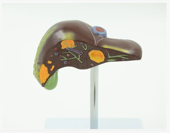 PVC Pathological Liver Model Visualize Common Hepatic & Gallbladder Disorders