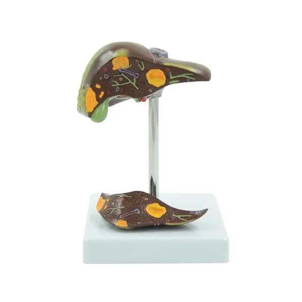 PVC Pathological Liver Model Visualize Common Hepatic & Gallbladder Disorders