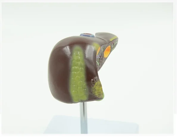 PVC Pathological Liver Model Visualize Common Hepatic & Gallbladder Disorders