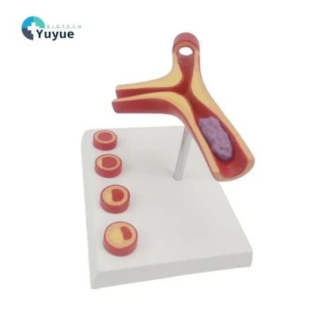 Y-Shaped Artery Atherosclerosis Model with Thrombus PVC Blood Vessel Anatomical Manikin for Medical Science Training Hospitals
