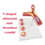 Y-Shaped Artery Atherosclerosis Model with Thrombus PVC Blood Vessel Anatomical Manikin for Medical Science Training Hospitals
