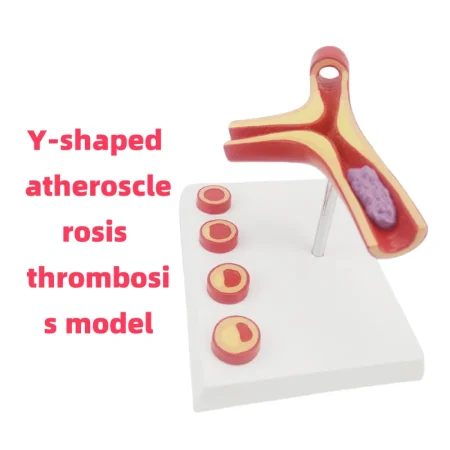 Y-Shaped Artery Atherosclerosis Model with Thrombus PVC Blood Vessel Anatomical Manikin for Medical Science Training Hospitals